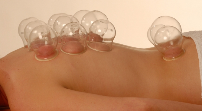 Schröpfanwendung in der Physiotherapie